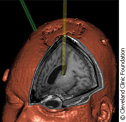 Computer generated picture of a brain as it recieves deep brain stimulation